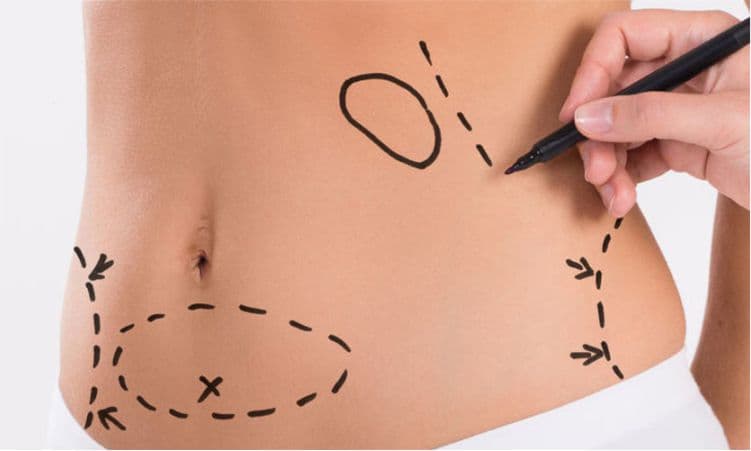 Abdominoplastia