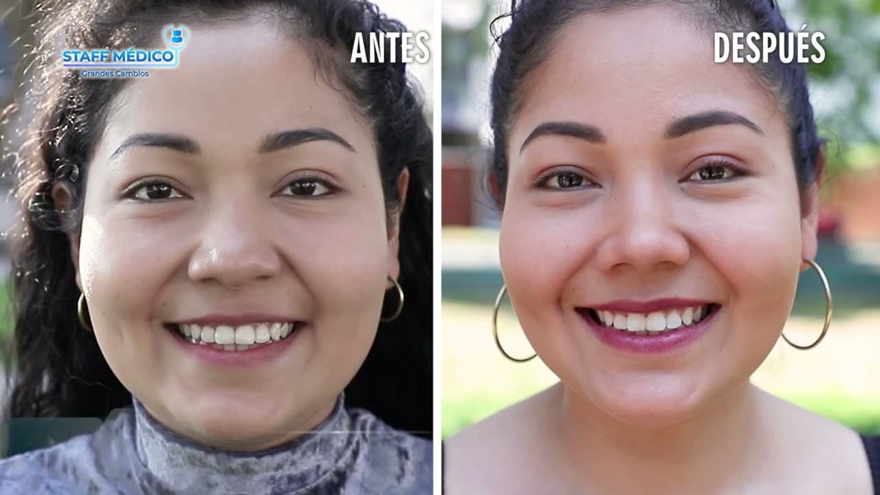 PERFILOPLASTIA: Rinoplastia + Afinamiento facial