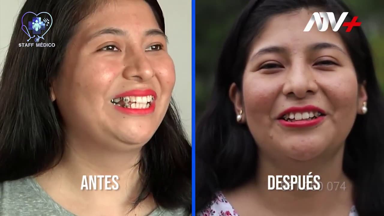 Liposucción de papada: antes y después