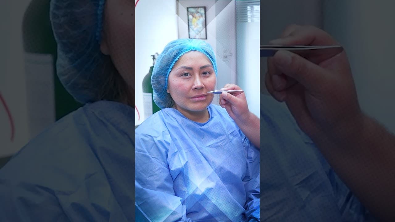 Descubre todo sobre el Lip Lift